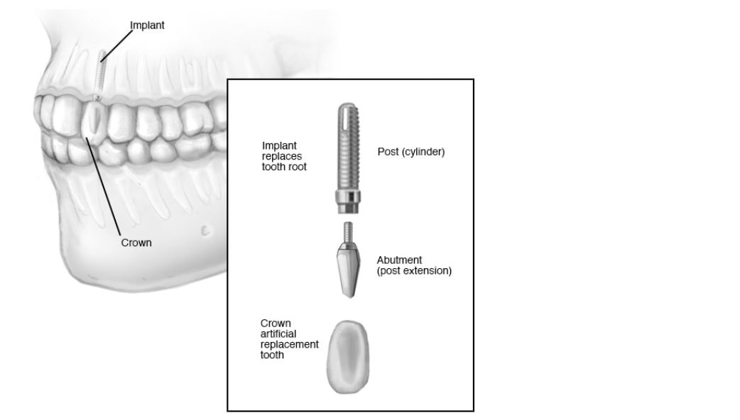 Zavedenie zubných implantátov