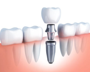 Z čoho sa skladá zubný implantát